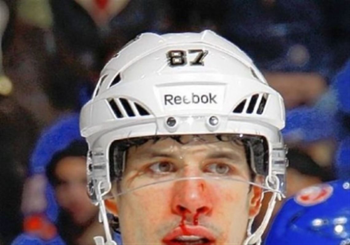 Sidney Crosby sports the effects under his nose of getting hit by the puck early in the second period Tuesday night. Crosby returned before the period.