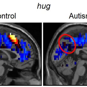 Above, fMRI images show brain activity in a subject without autism, left, and a subject with autism, right, when both individuals thought about the word and the concept of 