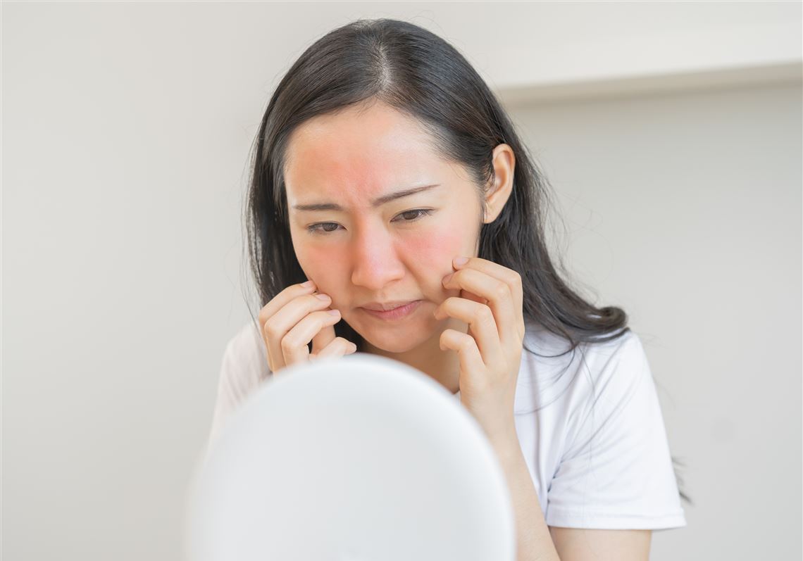 Researchers at the University of Pittsburgh may have uncovered a new way to treat rosacea and other inflammatory skin conditions by targeting mast cells, a key player in immune responses.